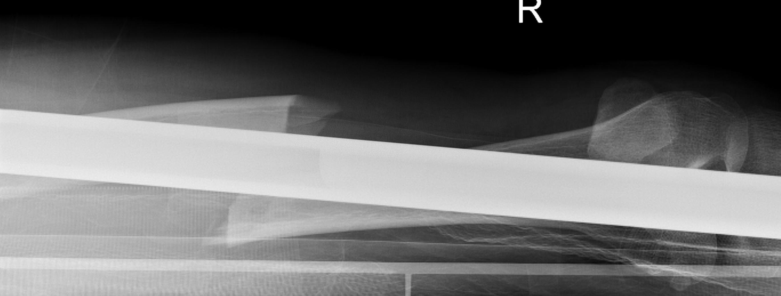 Femoral Shaft Fracture Standard Displacement Lateral